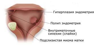 Гистероскопия_осложнения